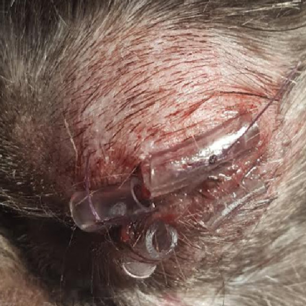 How to Prepare for a Proptosis