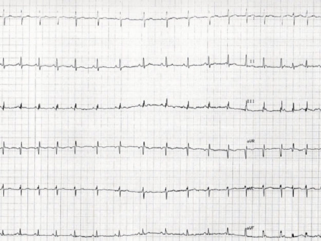 TVL0012-Tile Feline Murmurs, Gallops, & Dysrhythmias: When Should I Investigate/Refer?