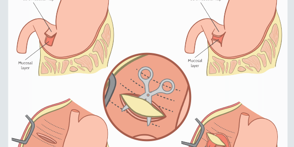 Circumcostal Gastropexy Technique