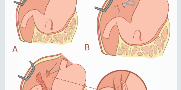 Belt Loop Gastropexy Technique