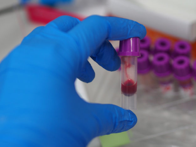 Blood Smear Evaluation: The Basics